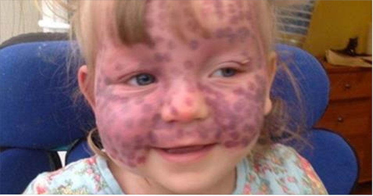 DAUGHTER IS BORN WITH RARE BIRTHMARK ON HER FACE, BUT THEN DOCTORS TELL
