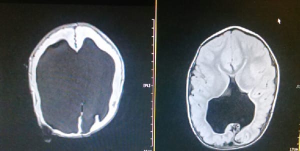 PIC FROM CATERS NEWS - (PICTURED: The scan on the (L) was when Noah was just born showing 2% brain function compared to the scan on the right which shows that his brain has almost completed full function ) -A brave toddler who was born with just 2% brain function has dumbfounded doctors after he recovered nearly all of its ability. Michelle Wall and her husband Rob were warned their unborn son Noah was unlikely to survive birth as it became apparent a back quarter of his brain was missing. On July 10, despite being told he would be paralysed from the chest down and suffer with spina bifida, the three-year-old shocked doctors after showing his brain miraculously had almost full function. SEE CATERS COPY.