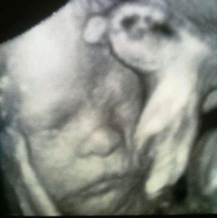 PIC FROM CATERS NEWS - (PICTURED: A picture of Noah when he was in the womb) - A brave toddler who was born with just 2% brain function has dumbfounded doctors after he recovered nearly all of its ability. Michelle Wall and her husband Rob were warned their unborn son Noah was unlikely to survive birth as it became apparent a back quarter of his brain was missing. On July 10, despite being told he would be paralysed from the chest down and suffer with spina bifida, the three-year-old shocked doctors after showing his brain miraculously had almost full function. SEE CATERS COPY.