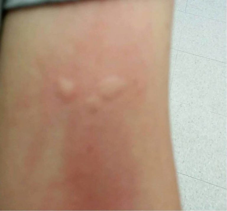 Officials Are Warning People About Gypsy Moth Caterpillars And The