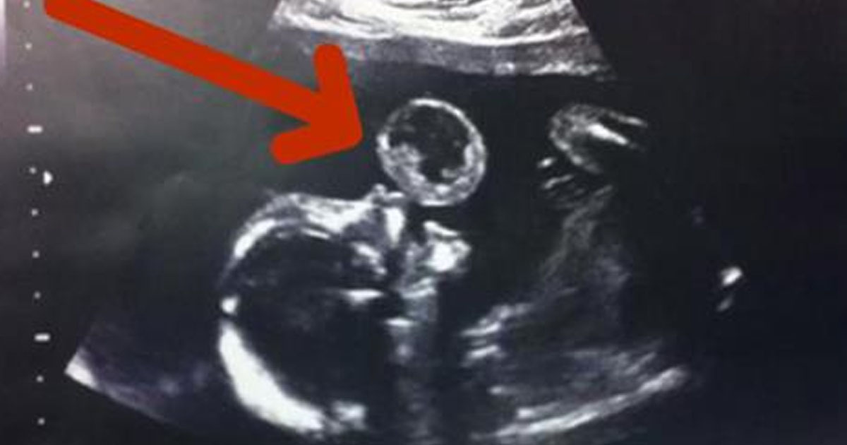 The ultrasound looks like the baby is blowing a bubble. What the doctor
