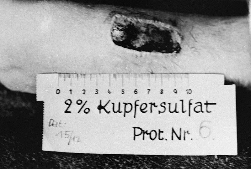 nazi-medicine-ravensbruck-phosphorous