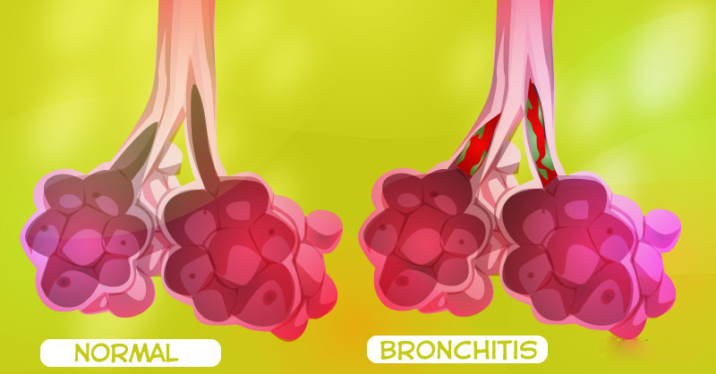 bronchitis_1
