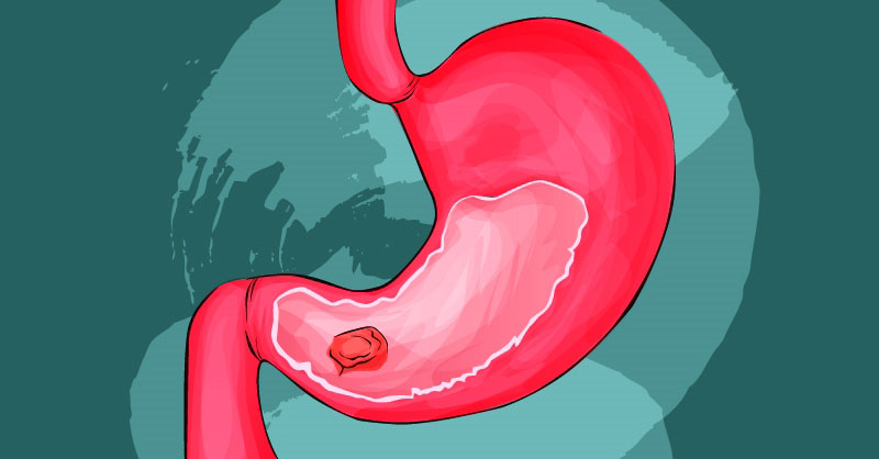 stomach-cancer_1