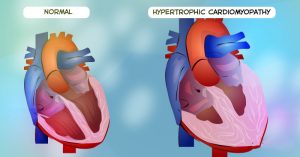 cardiomyopathy abrozzi