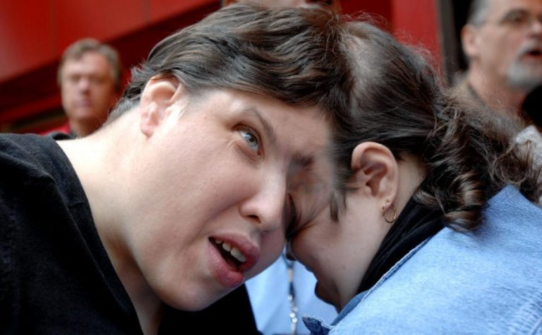 15 Real Conjoined Twins And Their Stories: - us.abrozzi.com
